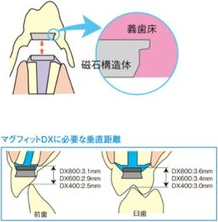 マグフィット義歯