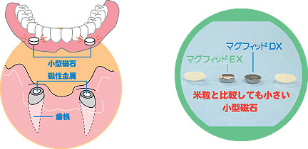 マグフィット義歯