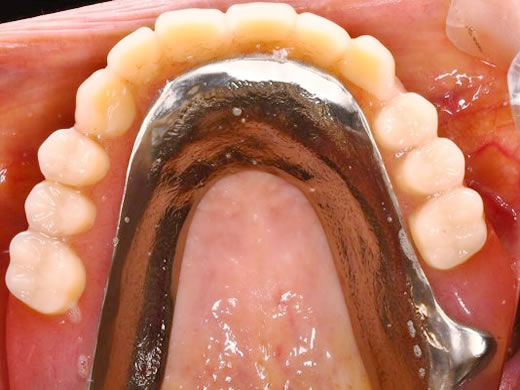 入れ歯の事例 | 豊中市で歯科なら一般歯科・小児歯科から審美・入れ歯